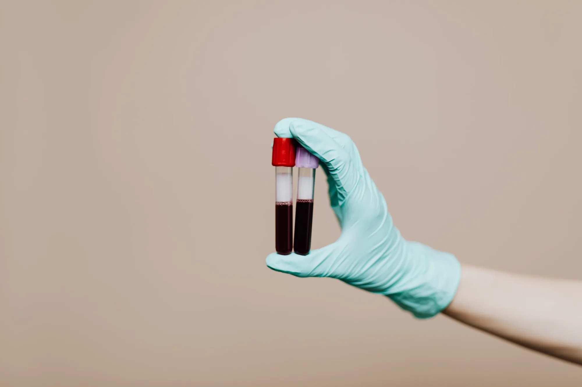Mano con guante sostiene tubos con muestras de sangre antes de separar el plasma rico en plaquetas