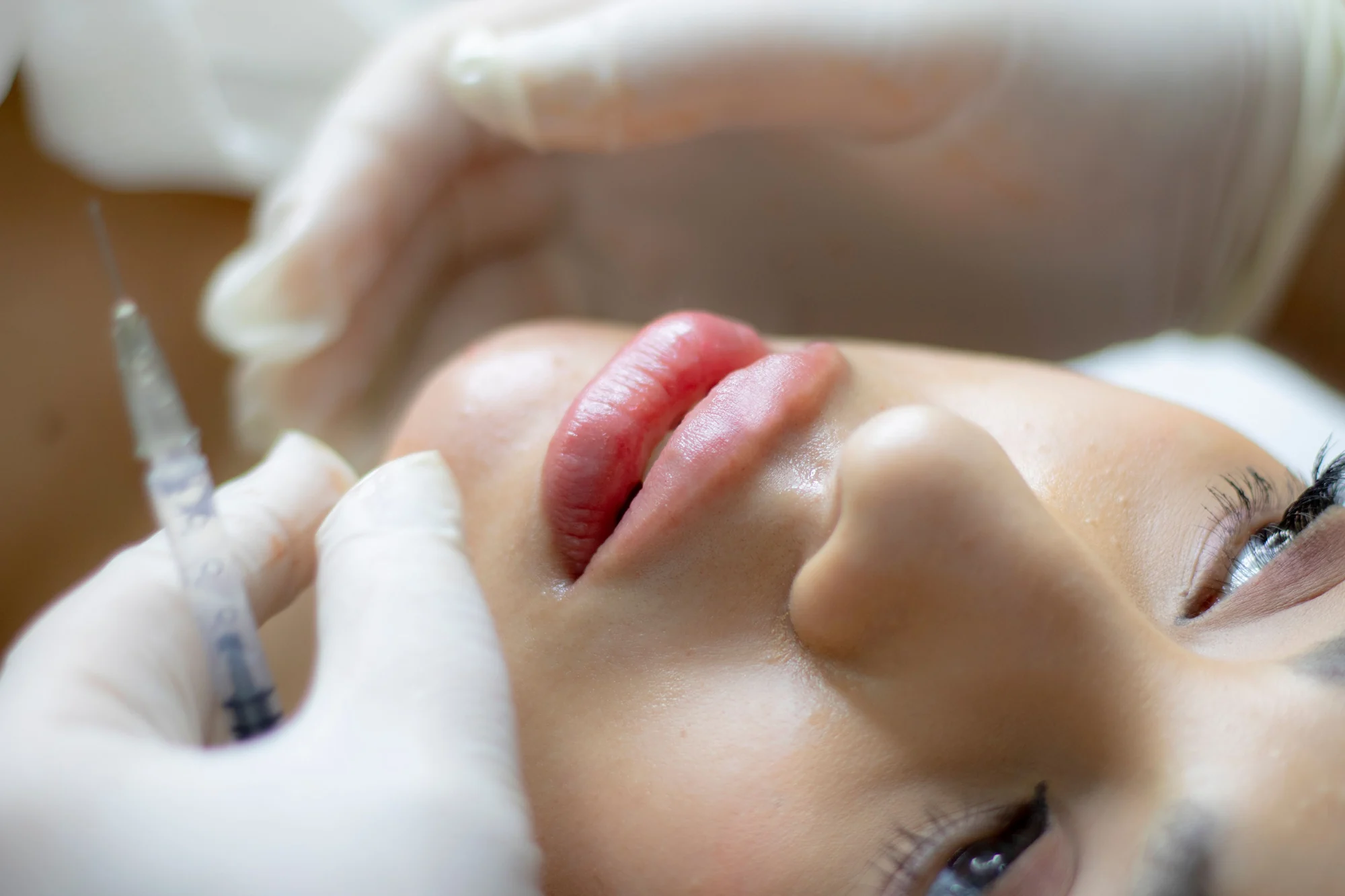 Microinyección superficial en la mejilla con guantes, técnica de vitaminización facial